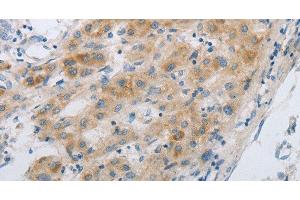 Immunohistochemistry of paraffin-embedded Human liver cancer using GJB6 Polyclonal Antibody at dilution of 1:30 (GJB6 抗体)
