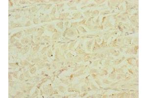 Immunohistochemistry of paraffin-embedded human gastric cancer using ABIN7151546 at dilution of 1:100 (EEF1G 抗体  (AA 168-437))