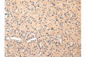 The image on the left is immunohistochemistry of paraffin-embedded Human liver cancer tissue using ABIN7190330(COL8A2 Antibody) at dilution 1/20, on the right is treated with synthetic peptide. (COL8a2 抗体)