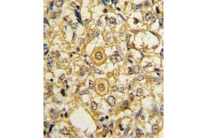 Formalin-fixed and paraffin-embedded human breast carcinoma reacted with PDGFRB Antibody (N-term), which was peroxidase-conjugated to the secondary antibody, followed by DAB staining. (PDGFRB 抗体  (N-Term))