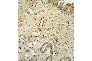 Immunohistochemistry analysis in formalin fixed and paraffin embedded bladder carcinoma reated with ID4 Antibody (N-term) followed which was peroxidase conjugated to the secondary antibody and followed by DAB staining.