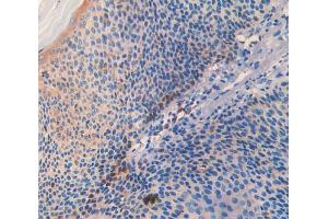 IHC-P analysis of skin cancer tissue, with DAB staining. (SLIT3 抗体  (AA 1405-1512))