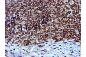 Immunohistochemical staining of paraffin-embedded Adenocarcinoma of Human breast tissue using anti-RFXANK mouse monoclonal antibody. (RFXANK 抗体)