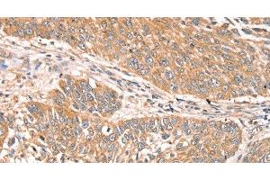 Immunohistochemistry of paraffin-embedded Human lung cancer using RPS6KA1 Polyclonal Antibody at dilution of 1:30 (RPS6KA1 抗体)