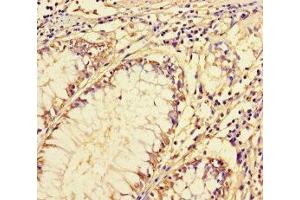 Immunohistochemistry of paraffin-embedded human colon cancer using ABIN7143489 at dilution of 1:100 (ARL16 抗体  (AA 1-197))