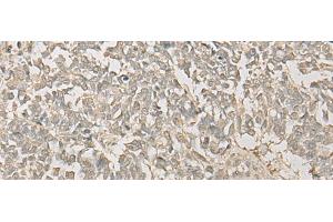 Immunohistochemistry of paraffin-embedded Human lung cancer tissue using FYTTD1 Polyclonal Antibody at dilution of 1:30(x200) (FYTTD1 抗体)