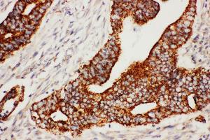 Anti-Secretogranin 3 antibody, IHC(P) IHC(P): Human Rectal Cancer Tissue (SCG3 抗体  (C-Term))
