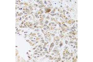 Immunohistochemistry of paraffin-embedded human lung cancer using RNASEL antibody. (RNASEL 抗体)