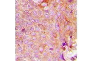 Immunohistochemical analysis of MRPS9 staining in human breast cancer formalin fixed paraffin embedded tissue section. (MRPS9 抗体)