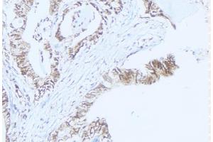 ABIN6275467 at 1/100 staining Human lung cancer tissue by IHC-P. (RAB37 抗体  (C-Term))