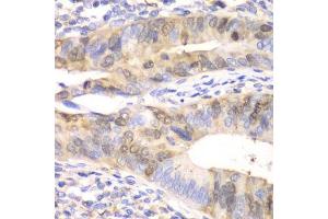 Immunohistochemistry of paraffin-embedded human colon carcinoma using UBE2C antibody. (UBE2C 抗体  (AA 1-179))