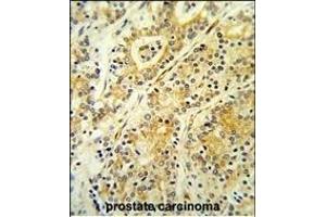 Formalin-fixed and paraffin-embedded human prostate carcinoma reacted with MGST2 Antibody (C-term),which was peroxidase-conjugated to the secondary antibody, followed by DAB staining. (MGST2 抗体  (C-Term))