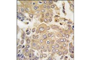 Formalin-fixed and paraffin-embedded human lung carcinoma tissue reacted with MAPK4 antibody (N-term), which was peroxidase-conjugated to the secondary antibody, followed by DAB staining. (MAPK4 抗体  (N-Term))