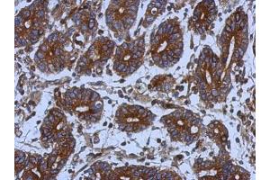 IHC-P Image Immunohistochemical analysis of paraffin-embedded human colon carcinoma, using alpha Tubulin, antibody at 1:500 dilution. (TUBA1B 抗体)