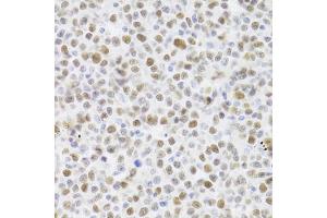 Immunohistochemistry of paraffin-embedded human B cell lymphoma using TP53 Antibody (ABIN5971632) at dilution of 1/100 (40x lens). (p53 抗体)