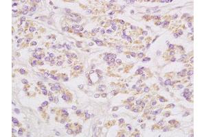 Formalin-fixed and paraffin embedded human cervical carcinoma labeled with Anti-Connexin-32 Polyclonal Antibody, Unconjugated  at 1:200 followed by conjugation to the secondary antibody and DAB staining (GJB1 抗体  (AA 201-283))