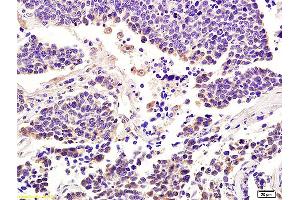 Formalin-fixed and paraffin embedded human lung carcinoma labeled with Anti-Integrin alpha 7/ITGA7 Polyclonal Antibody, Unconjugated (ABIN734858) at 1:200 followed by conjugation to the secondary antibody and DAB staining. (ITGA7 抗体  (AA 701-800))