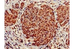 Immunohistochemistry of paraffin-embedded human ovarian cancer using ABIN7170803 at dilution of 1:100 (STOML3 抗体  (AA 205-291))