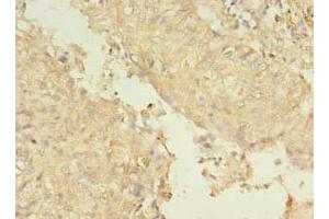 Immunohistochemistry of paraffin-embedded human lung cancer using ABIN7151226 at dilution of 1:100 (SMURF2 抗体  (AA 1-748))