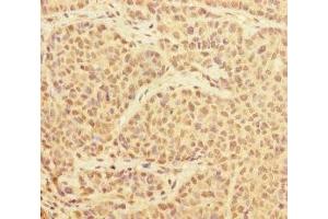 Immunohistochemistry of paraffin-embedded human ovarian cancer using ABIN7174174 at dilution of 1:100 (PRPF4 抗体  (AA 1-260))