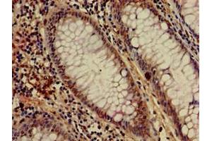 Immunohistochemistry of paraffin-embedded human colon cancer using ABIN7155043 at dilution of 1:100 (c-MET 抗体  (AA 83-209))