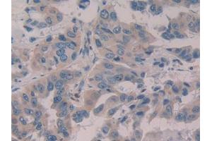 DAB staining on IHC-P; Samples: Human Breast cancer Tissue (WISP1 抗体  (AA 216-347))