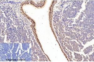 Immunohistochemical analysis of paraffin-embedded human lung cancer tissue. (Collagen Type I 抗体)