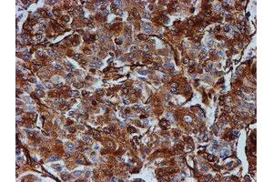 Immunohistochemical staining of paraffin-embedded Carcinoma of Human liver tissue using anti-TUBB4 mouse monoclonal antibody. (TUBB4 抗体)