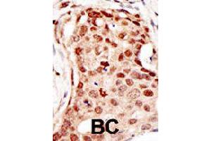 Formalin-fixed and paraffin-embedded human cancer tissue reacted with CBLC polyclonal antibody  , which was peroxidase-conjugated to the secondary antibody, followed by DAB staining. (CBLC 抗体  (C-Term))