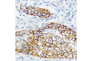 Immunohistochemistry of paraffin-embedded human esophageal cancer using Collagen XVII/COL17 Rabbit mAb (ABIN7266467) at dilution of 1:100 (40x lens). (COL17A1 抗体)