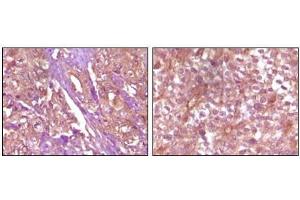 Immunohistochemical analysis of paraffin-embedded Human pancreas carcinoma (left) and breast carcinoma (right) tissue, showing membrane and cytoplasmic (pancreas carcinoma) localization, membrane (breast carcinoma) localization using EphB4 antibody with DAB staining. (EPH Receptor B4 抗体)