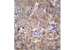 Formalin fixed and paraffin embedded human hepatocarcinoma reacted with DEF Antibody (N-term) followed by peroxidase conjugation of the secondary antibody and DAB staining (C11ORF58 抗体  (N-Term))
