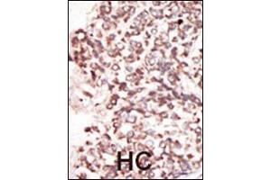 Formalin-fixed and paraffin-embedded human cancer tissue reacted with the primary antibody, which was peroxidase-conjugated to the secondary antibody, followed by DAB staining. (PIM2 抗体  (C-Term))