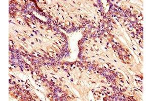 Immunohistochemistry of paraffin-embedded human breast cancer using  at dilution of 1:100 (CDKN2A 抗体  (AA 1-86))