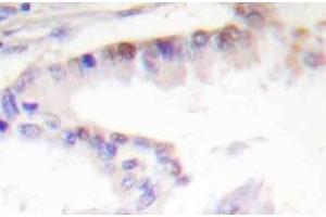 Immunohistochemistry (IHC) analyzes of CREB-1 antibody in paraffin-embedded human lung carcinoma tissue. (CREB1 抗体)