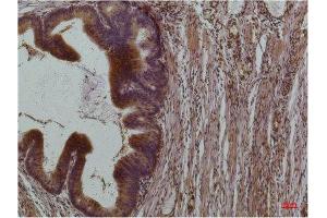 Immunohistochemistry (IHC) analysis of paraffin-embedded Human Colon Carcinoma using STAT3 Mouse Monoclonal Antibody diluted at 1:200. (STAT3 抗体)