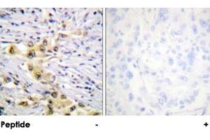 Immunohistochemical analysis of paraffin-embedded human lung carcinoma tissue using IGF2R polyclonal antibody . (IGF2R 抗体)