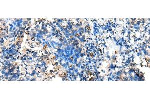 Immunohistochemistry of paraffin-embedded Human lung cancer tissue using NUDT10 Polyclonal Antibody at dilution of 1:70(x200) (NUDT10 抗体)