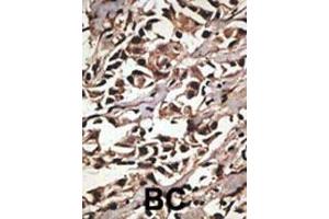 Formalin-fixed and paraffin-embedded human cancer tissue reacted with the primary antibody, which was peroxidase-conjugated to the secondary antibody, followed by DAB staining. (PRMT7 抗体  (C-Term))