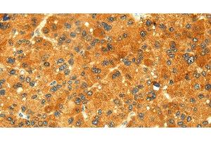 Immunohistochemistry of paraffin-embedded Human liver cancer tissue using GK1 Polyclonal Antibody at dilution 1:60 (Glycerol Kinase 抗体)