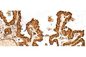 Immunohistochemistry of paraffin-embedded Human thyroid cancer tissue using FAM200A Polyclonal Antibody at dilution of 1:55(x200) (FAM200A 抗体)