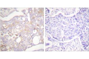 Peptide - +Immunohistochemical analysis of paraffin-embedded human breast carcinoma tissue using Claudin 4 antibody (#C0141). (Claudin 4 抗体)