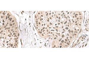 Immunohistochemistry of paraffin-embedded Human esophagus cancer tissue using ERH Polyclonal Antibody at dilution of 1:55(x200) (ERH 抗体)