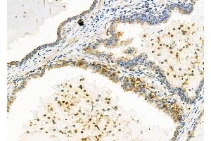 ABIN6257891 and ABIN6273815 at 1/100 staining Human prostate cancer by IHC-P. (TRIO 抗体  (Internal Region))