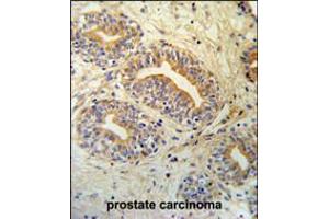 CWC15 Antibody IHC analysis in formalin fixed and paraffin embedded prostate carcinoma followed by peroxidase conjugation of the secondary antibody and DAB staining. (CWC15 抗体  (AA 123-152))