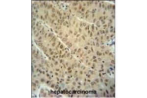 WDR32 antibody (N-term) (ABIN654593 and ABIN2844292) immunohistochemistry analysis in formalin fixed and paraffin embedded human hepatocarcinoma followed by peroxidase conjugation of the secondary antibody and DAB staining. (DCAF10 抗体  (N-Term))