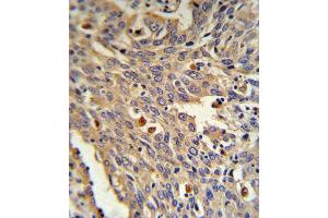 GLA Antibody (N-term) (ABIN390687 and ABIN2840977) IHC analysis in formalin fixed and paraffin embedded human Lung carcinoma followed by peroxidase conjugation of the secondary antibody and DAB staining. (GLA 抗体  (N-Term))