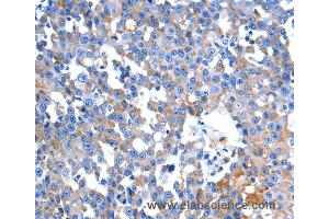 Immunohistochemistry of Human colon cancer using HINT2 Polyclonal Antibody at dilution of 1:60 (HINT2 抗体)