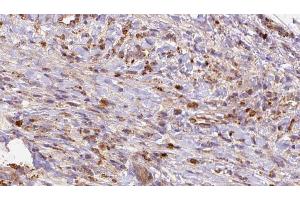 ABIN6272697 at 1/100 staining Human liver cancer tissue by IHC-P. (GRM2 抗体  (Internal Region))