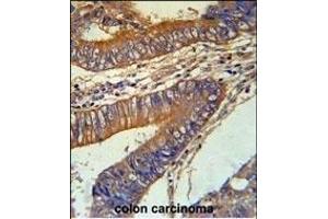 KLC3 Antibody (Center) (ABIN651542 and ABIN2840291) immunohistochemistry analysis in formalin fixed and paraffin embedded human colon carcinoma followed by peroxidase conjugation of the secondary antibody and DAB staining. (KLC3 抗体  (AA 245-274))